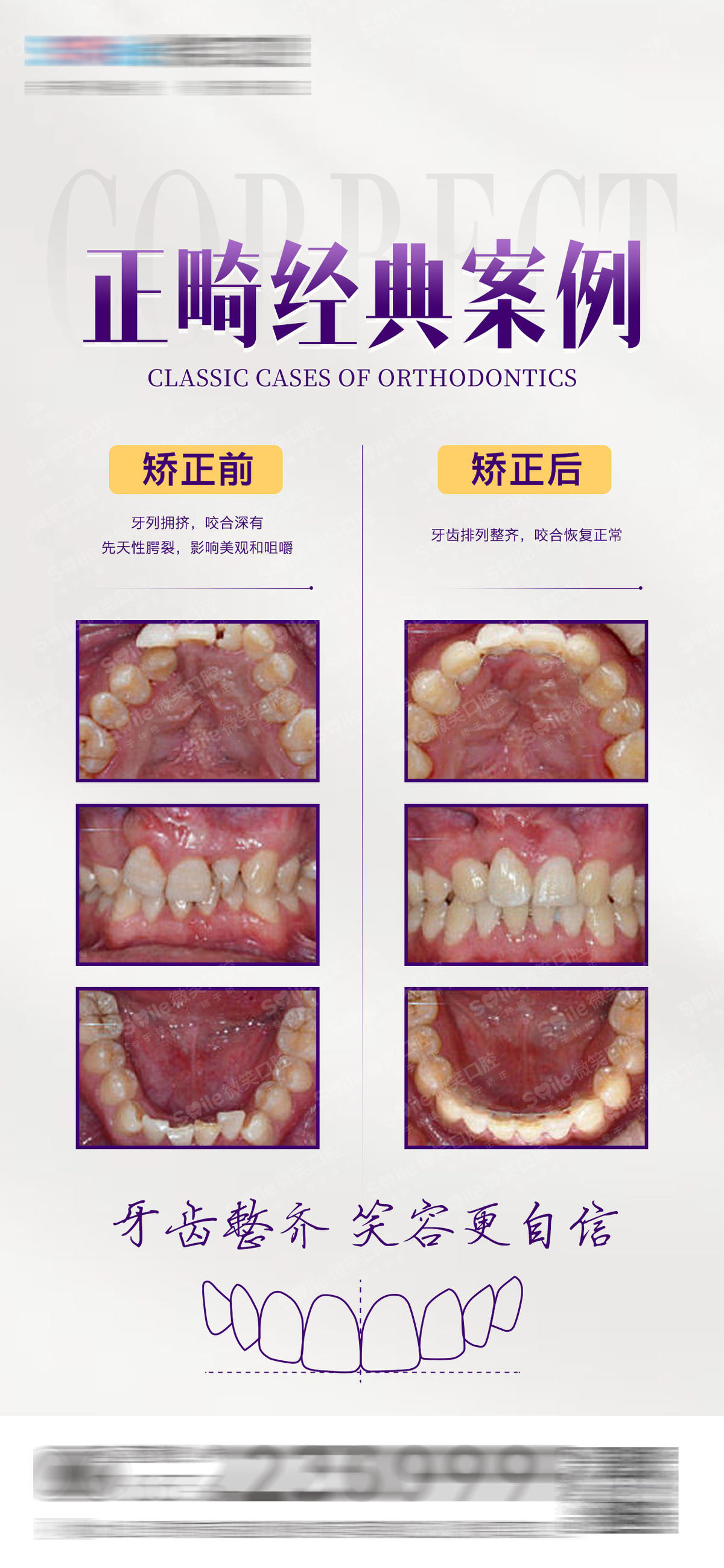 医美口腔正畸案例对比海报