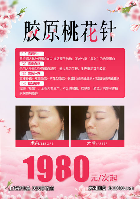 胶原桃花针案例对比价格-源文件-素材国度dc10000.com